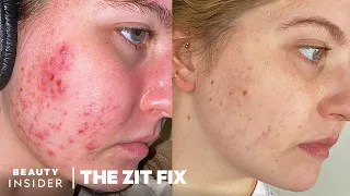 My 8-Month Accutane Journey: Side Effects And Results | The Zit Fix
