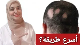 العلاج النهائى للثعلبة بكل أنواعها (اعادة انبات الشعر)