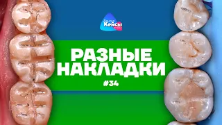 Разные накладки | Дентал Кейсы от BG #34