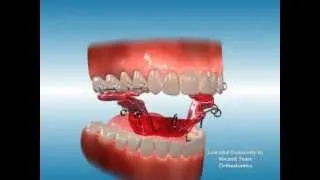 Palatal Expander