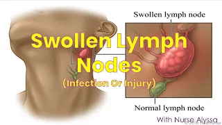 Swollen Lymph Nodes (infection and injury)