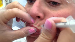 Обучение ботокс периоральная зона область вокруг губ