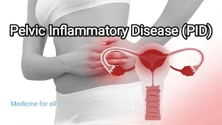 Pelvic Inflammatory Disease (PID) - causes, symptoms, diagnosis, treatment