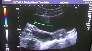 ENDOMETRIAL  PATHOLOGY