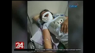 24 Oras: Babae, nalapnos ang bahagi ng mukha matapos sabuyan ng hinihinalang asido