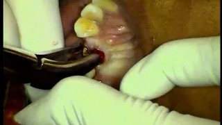 Extraction tooth #5 broken to gumline utilzing Physics Forceps 69