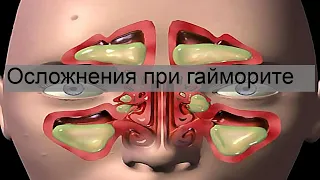 Осложнения при гайморите