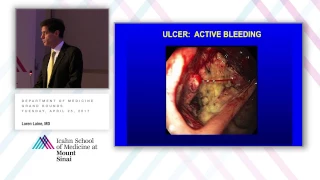 Management of Upper GI Bleeding