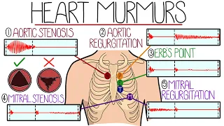 Learn Heart Murmurs In 10 Minutes (With Heart Murmur Sounds)