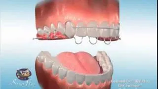 ES Ortho and AOB (Anterior Open Bite) Retainers