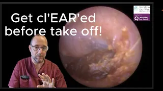 Get cl'EAR'ed before take off! Episode 108 #ear #earwaxremoval #earwax  #earwaxclinic