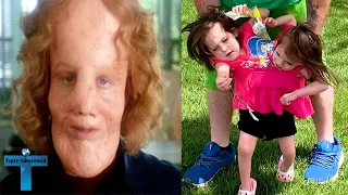 Top 10 Amazing And Unusual Kids Born With Rare Medical Conditions