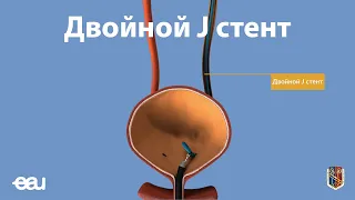 Двойной J стент (EAU - JJ stent RU)