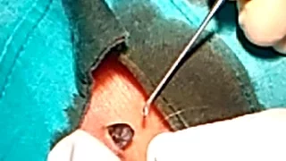 Biggest Blackhead Removal / Blackhead Popping / Comedo / Dilated Pore of Winer Extraction