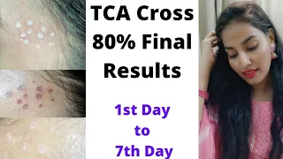 TCA Cross Final Results||TCA Cross के परीणाम||  Before After Results|| 1st Day to 7th Day||