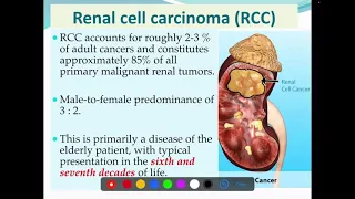 Renal cell carcinoma ( RCC ; Aetiology , Histopathology , spread)