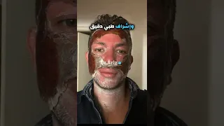 تقشير الوجه باستخدام الفينول