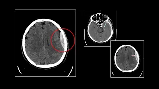 Neuro Trauma I | Interesting Radiology Cases