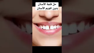 حل مشكلة فلجة الأسنان بدون تقويم