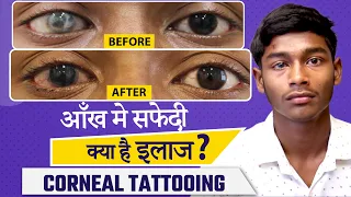 काली पुतली में सफेदी का इलाज - Corneal Tattooing