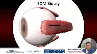 Kaye Family Learning Day 2023: Extra-Ocular Muscle Biopsy