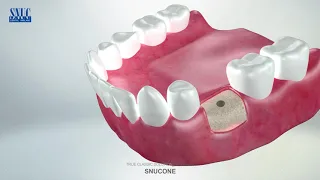 #임플란트식립방법  #Dental Implant #Snucone Implant  # Implant processing