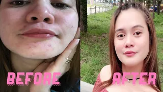 How to remove pimples |MaryjoeyPH