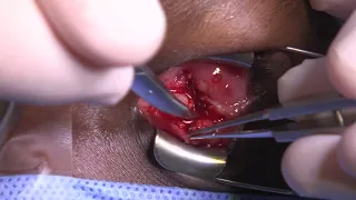 Surgery: Orbital Implant