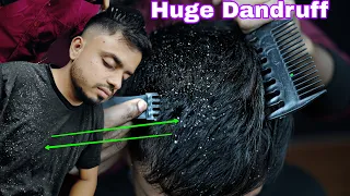 Huge Dandruff Removal From Sculp | ASMR Dandruff Scratching | Satisfying Dandruff Treatment ASMR