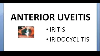 Ophthalmology 162 Anterior Uveitis Iritis IridoCyclitis Non suppurative glaucoma mechanism treatment