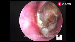 A case of ear canal cholesteatoma with severe bone destruction