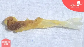 1,172 - Long Dead Skin Ribbon & Ear Wax Removal Compilation