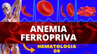 ANEMIA FERROPRIVA (ANEMIA POR DEFICIÊNCIA DE FERRO) - HEMATOLOGIA | ESTUDO DAS ANEMIAS