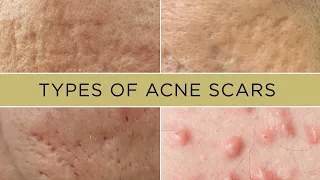 How to treat different TYPES OF ACNE SCARS