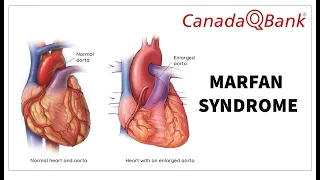 Marfan Syndrome