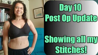 Post Op Day 10 update/ Medial Thigh Lift, Arm Lift, Breat Augementation, Lipo