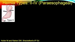 Dr. Steve DeMeester and IHC: paraesophageal hernia Part 1/3