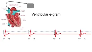 Common pacemaker problems part 3： Oversensing