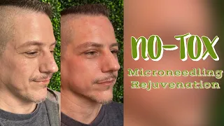 Before & After - No-Tox Microneedling Rejuvination Treatment