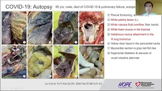 Yu Du, MD - A Perspective on the Chinese Experience with COVID-19
