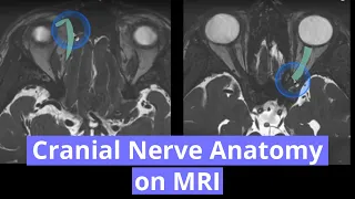 Cranial Nerve Anatomy on MRI