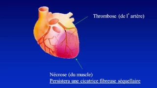 5 à 7: Dépister et prévenir l'insuffisance cardiaque