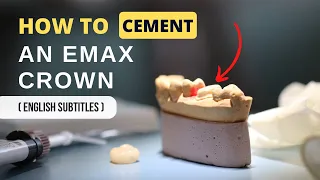 How to Cement an Emax Crown (Glass Ceramic Crown)