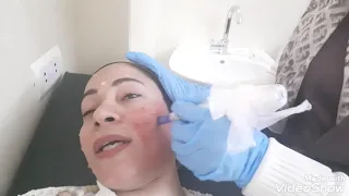 تجربتي مع الديرما بن 🤗جلسة ديرما بن Dermapen