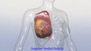 Breast Pedicle Surgery Animation