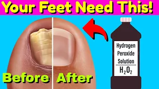 Put Hydrogen Peroxide On Your Feet: Amazing Results & Benefits Revealed!