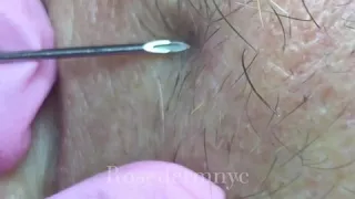 Ingrown hair removal/ extraction