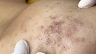 Treating Teen Acne | Điều Trị Mụn Cho Bạn Nam Tuổi Dậy Thì - SacDepSpa#316