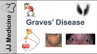 Graves Disease and Graves Ophthalmopathy | Signs, Symptoms, Diagnosis and Treatment