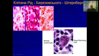 Лімфоми та мієломна хвороба. Доцент Павло Володимирович Матюхін